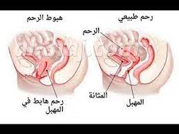 شكل الرحم النازل نزول الرحم واشكاله المختلفه اثارة مثيرة