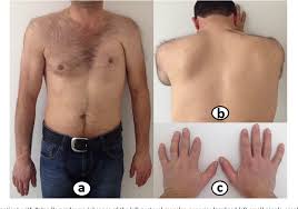 Poland syndrome is characterized by unilateral absence of the sternocostal head of the pectoralis muscle combined with ipsilateral short and webbed fingers. Figure 1 From The Abnormalities Of Trapezius Muscle Might Be A Component Of Poland S Syndrome Semantic Scholar