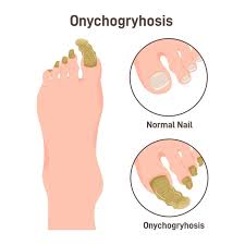 Image result for Onychogryphosis feet
