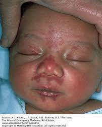 Image result for Nevus Simplex