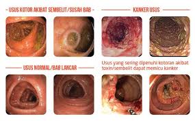 Image result for usus besar kolesterol