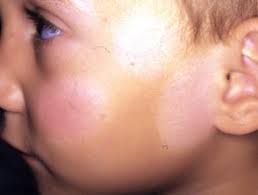 Most patients have a history of atopy, and pityriasis alba may be a minor manifestation of atopic dermatitis. Pityriasis Alba Dermatly Com Ihre Hautseite