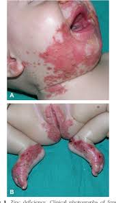 Image result for Zinc Deficiency