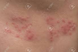 Die patienten erkranken an einer meningitis.gelangen die viren in das gesamte nervensystem,kommt es in schweren fällen zu einer unmittelbaren körperlähmung. Nahaufnahme Der Korperhaut Mit Herpes Zoster Gurtelrose Lizenzfreie Fotos Bilder Und Stock Fotografie Image 77241889