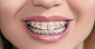 Different Types Of Braces Dallas Tx Ragan Orthodontics Orthodontics Braces Treatment Types Of Braces