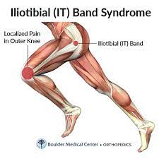 Knee Pain While Exercising Could Indicate It Band Syndrome Boulder Medical Center