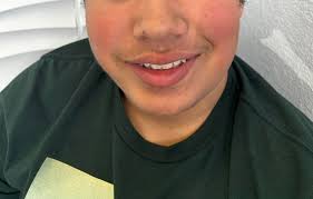 My son has always had red cheeks, which isn't common for someone with olive  skin tone. When he gets sun or sweats, they turn more red. These pictures  are of him naturally,