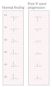 Normal p wave morphology and axis (upright in i and ii, inverted in avr) narrow qrs complexes (110 ms wide) Ecg Knowledge Amboss
