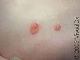 Image result for Eczema nummulare