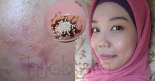 Waktu ade jerawat atau sekarang ade parut , korang perlu kurang/berhenti dulu ambil minuman berkafien. Hanya Guna Campuran Asam Jawa Bedak Sejuk Parut Jerawat Wanita Ini Hilang Dalam Masa Seminggu Wow Hijabista