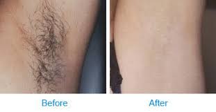 Although i'd suggest waiting for sales to happen for sure. Laser Hair Removal In India Laser Hair Removal Cost In Goa Surat