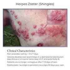 Image result for herpes zoster