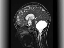 Headache, vision changes, vomiting, enlarged head circumference ,papilledema (optic disc/nerves at the back if child has infratentorial craniotomy, how should child lay? Which Treatment Is Best For Childhood Brain Tumors Global Trial Receives Funding Of Eur 2 2m Kitz