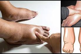 Terkadang beberapa orang mengalami kondisi tulang rusuk yang kaku, terutama pada daerah dada. 7 Penyebab Pergelangan Kaki Atau Kaki Membengkak Termasuk Awal Dari Penyakit Ini Kenali Gejala Dan Penyebab Penyebabnya Semua Halaman Intisari