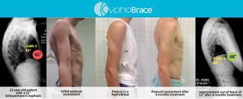 See full list on executivespinesurgery.com Scoliosis Bracing With Scolibrace Denver Physical Medicine