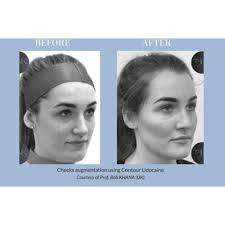 Pluryal Contour Lidocaine