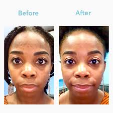 Dark Spot Remover Mdacne Hyperpigmentation Treatment Remove Dark Spots Hyperpigmentation Black Skin