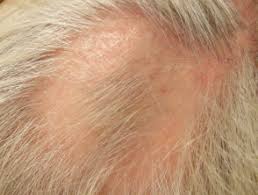 I have weak hair growth no mustache or beard i'm 29 years old. Intralesional Steroid Injection Dermnet Nz
