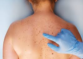 Image result for Merkel Cell Carcinoma