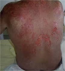 Doctor fauci started off by revealing who should be first in line to get the highly anticipated vaccine, the ones that have a more. References In Stevens Johnson Syndrome And Toxic Epidermal Necrolysis Induced By Amifostine During Head And Neck Radiotherapy Radiotherapy And Oncology