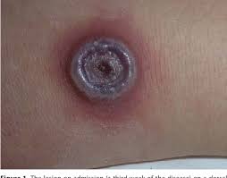 Cowpox can infect multiple animal species, including cows, cats and humans. Figure 1 From Cowpox After A Cat Scratch Case Report From Poland Semantic Scholar