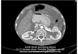 Thimble Bladder Sign Tuberculosis Involvement Of The Bladder May Cause Calcification In The Wall Which May Become Thick And Reduce Th Bladder Signs Radiology