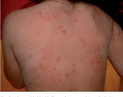 Pdf Sjogren Larsson Syndrome A Study Of Clinical Symptoms And Dermatological Treatment In 34 Swedish Patients Semantic Scholar