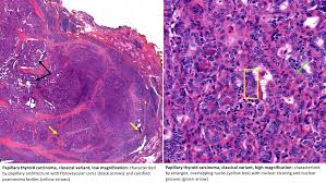 The tumors' empty nuclei reminded her of orphan annie's blank eyes in the popular comic strip. Variants Of Papillary Thyroid Carcinoma Microcarcinoma Tall Cell Columnar Follicular Iowa Head And Neck Protocols