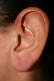Hole in the ear drum which occurs in a condition known as chronic otitis media needs to be treated by surgery known as tympanoplasty. Ear Reduction Surgery Uk To Correct Macrotia Making Big Ears Smaller