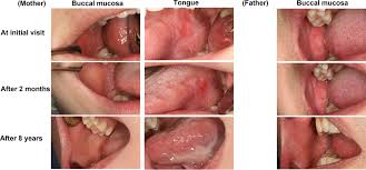 Image result for lichen planus on tongue)