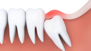 Are you looking for wisdom tooth pain relief solutions or wondering how long the wisdom tooth pain will last? Do Wisdom Teeth Make Me Smarter Maitland Ave Smile Co