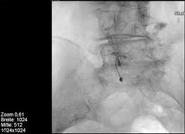 Therapeutische Infiltration An Der Wirbelsaule Schulthess Klinik