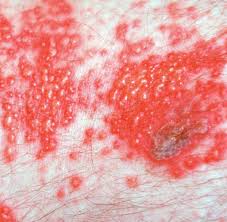Herpes Schmerzen Bei Gurtelrose Sind Oft Kaum Auszuhalten Welt