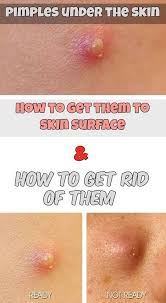 Wondering how to get rid of pimples or acne quickly? Fastest Ways To Get Rid Of A Pimple Pimples Under The Skin Acne On Nose Painful Pimple