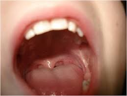 Should I Be Worried About A White Spot In My Mouth Herrick Dental