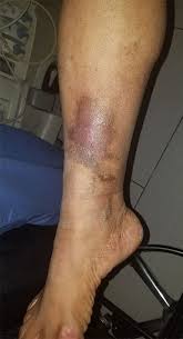 Image result for Lipodermatosclerosis