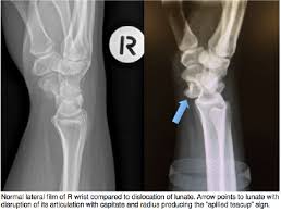Image result for Scapholunate Dislocation