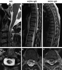 Image result for Myelitis