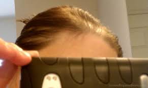 My hair is so thin, i ve to wear it all to one side, and it still doesnt look like what 'normal' hair looks like on. Spironolactone For Hair Loss Photo Corner Of Hope Mane