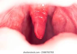 Image result for Uvulitis
