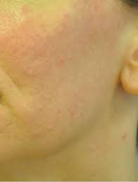 After spider vein treatment, blood vessels fade over several months, but they may not disappear completely. Facial Veins Diagnosis And Treatment Options The Pmfa Journal