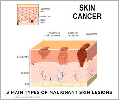 Biopsy involves removal of a small sample of tissue and examining it under a microscope. Skin Lesions And Biopsy Procedures Making A Diagnosis Medical Coding Buff