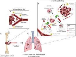 Initial imaging modality when evaluating a patient with symptoms concerning for lung cancer. Frontiers Understanding And Modeling Metastasis Biology To Improve Therapeutic Strategies For Combating Osteosarcoma Progression Oncology