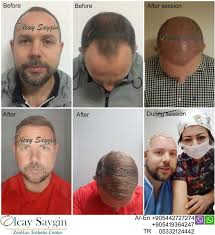 Best Hair Transplant Doctor In Turkey