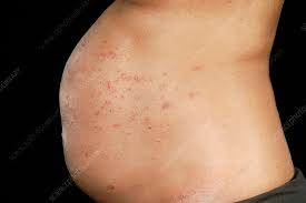 Image result for pruritic urticarial papules and plaques of pregnancy
