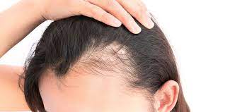 Si tratta di un vero e . Perdita Dei Capelli Condizione Fisiologica Anomala O Patologia