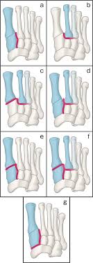 A lisfranc injury is an injury to the midfoot that often affects athletes in sports that involve sprinting and quickly changing directions, like football and soccer. Anatomical Pathology Of Subtle Lisfranc Injury Scientific Reports