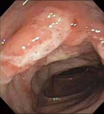 Crohn Disease Practice Essentials Background Pathophysiology