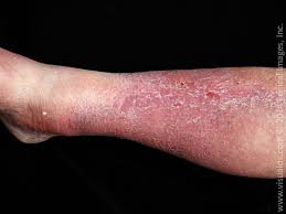 Cellulitis is a common, potentially serious bacterial skin infection. Cellulitis And Its Mimickers Visualdx