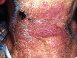 Uva rays also cause the unwelcome signs of premature aging, including dark spots and wrinkles. Cutaneous Metastasis Dermnet Nz